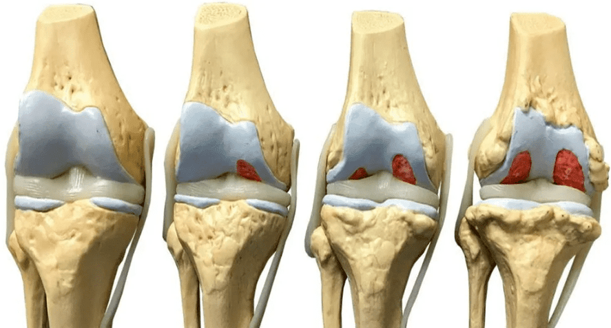 βλάβη στην άρθρωση του γόνατος σε διαφορετικά στάδια ανάπτυξης αρθρώσεων