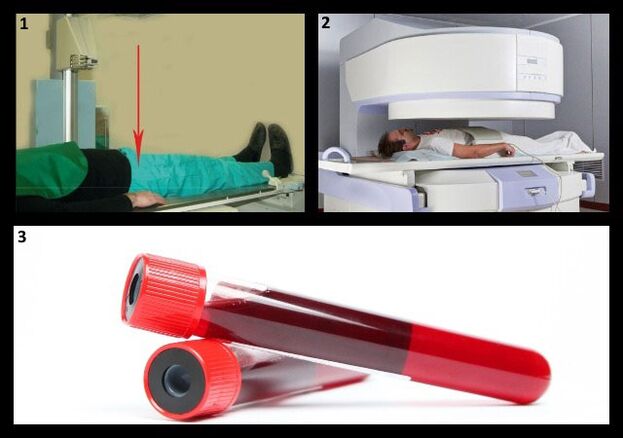 Μέθοδοι για τη διάγνωση της συνάρθρωσης - ακτινογραφία και μαγνητική τομογραφία της άρθρωσης του ισχίου, εξέταση αίματος