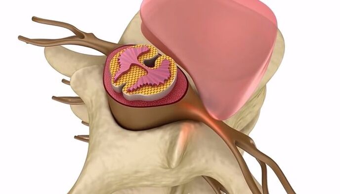 τραυματισμός της σπονδυλικής στήλης στη θωρακική οστεοχόνδρωση