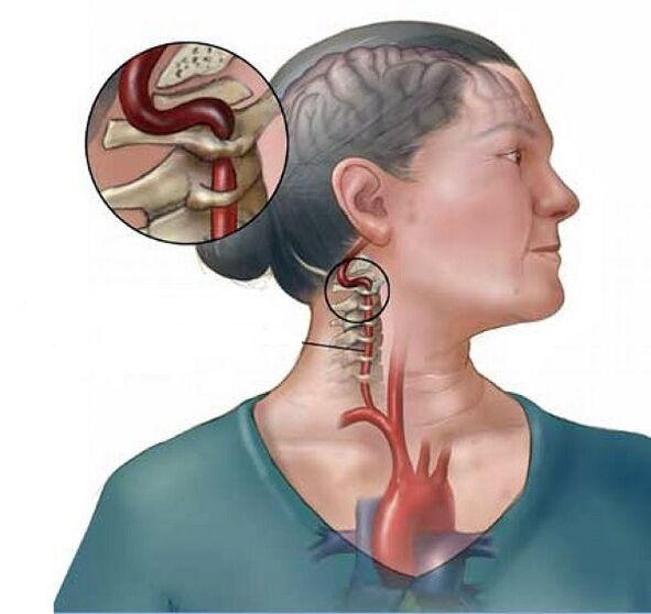 σύνδρομο σπονδυλικής αρτηρίας με αυχενική οστεοχόνδρωση